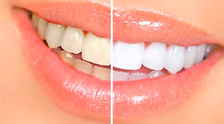 Foto Tratamento Clareamento Dental - Dra. Juliana Montes - Odontologia Koza