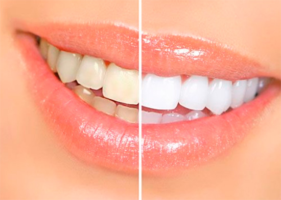 Foto Tratamento Clareamento Dental - Dra Juliana Montes - Odontologia