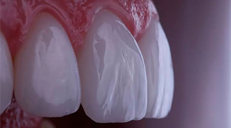 Foto Tratamento Lentes e Faceta Dental - Dra. Juliana Montes - Odontologia Koza