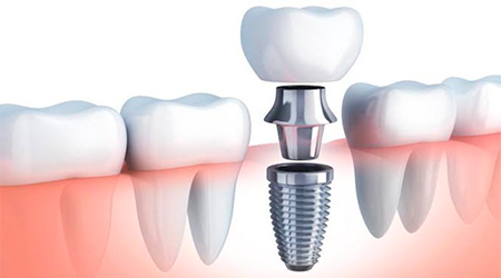 Foto Tratamento Implantes Dentários - Dra. Juliana Montes - Odontologia Koza