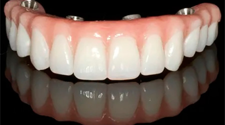 Foto Tratamento Próteses Dentárias - Dra. Juliana Montes - Odontologia Koza