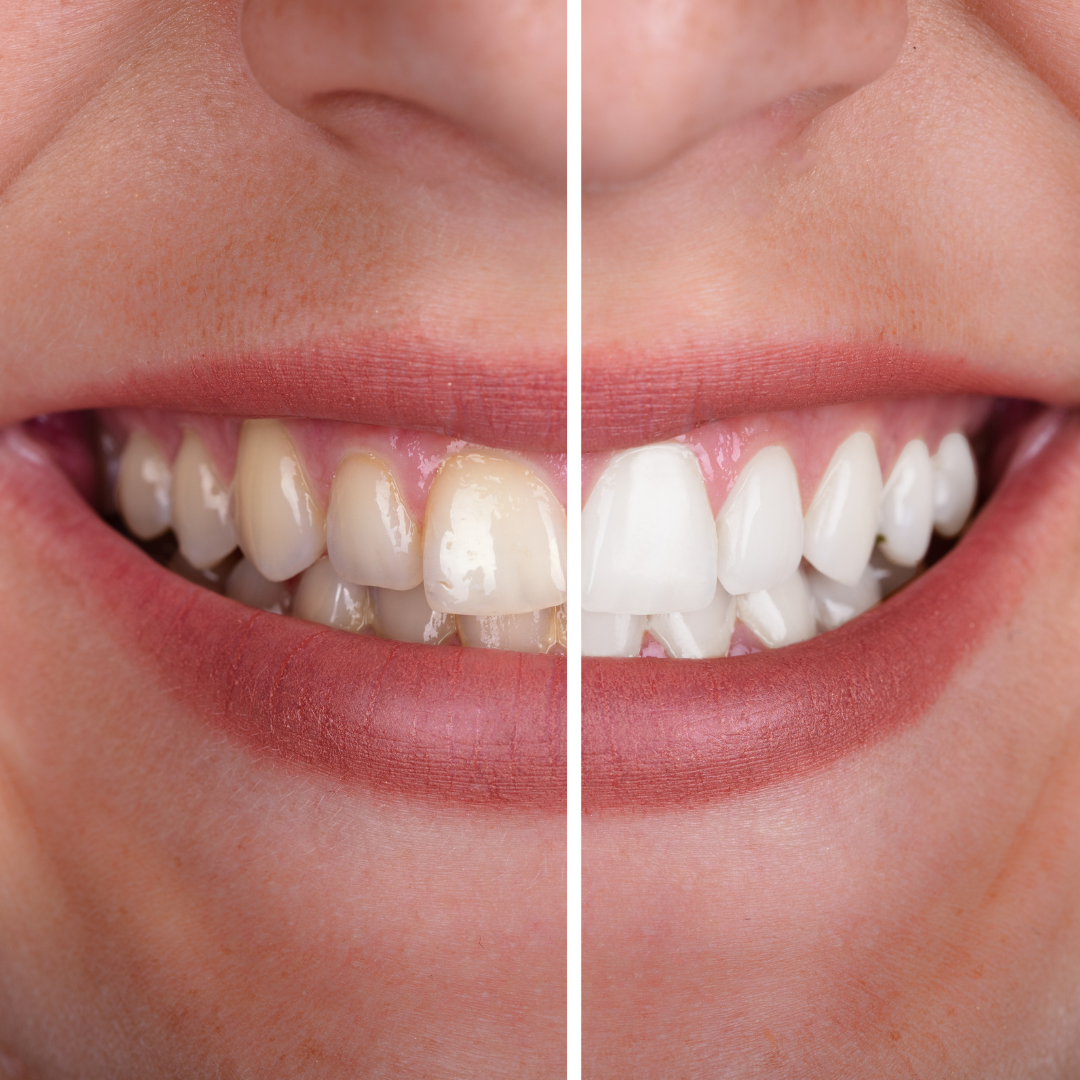 Clareamento dental