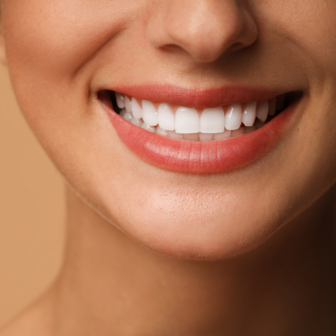 Facetas e lentes de contato dental